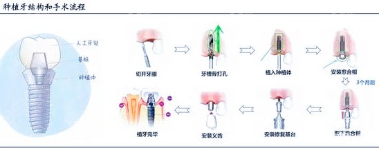最新种植牙技术，重塑笑容的神奇力量，让你自信闪耀每一天