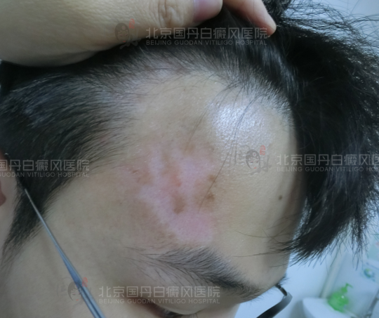 最新白癜风治疗方法，重塑自信人生之路