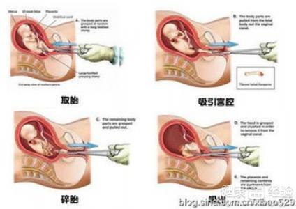 女性结扎最新方法与自然美景的治愈之旅